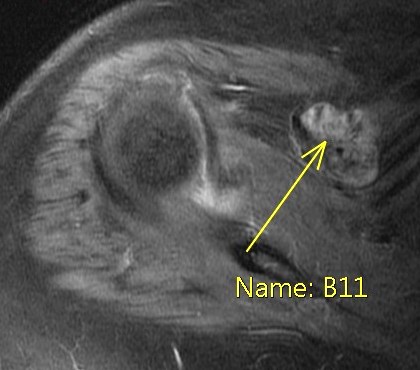 Figure 6 for case Gout ( RID3567 )